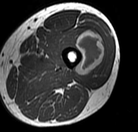 Intramuscular Hematoma Ultrasound