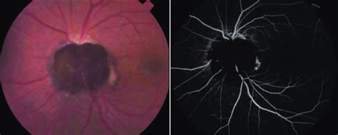 Fluorescein Angiography Optic Disk Melanocytoma Left Clinical Download Scientific Diagram