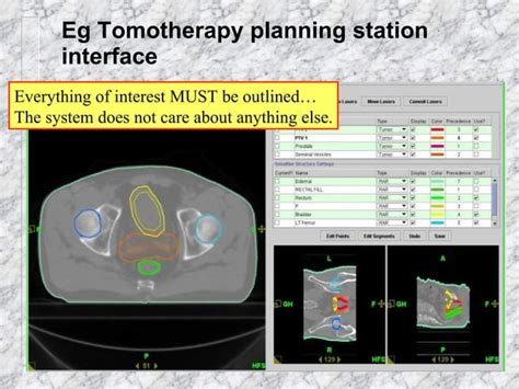 Imrt In Cervix Cancer