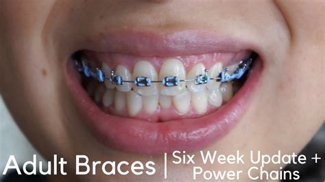 Adult Braces Six Week Update Power Chains Youtube