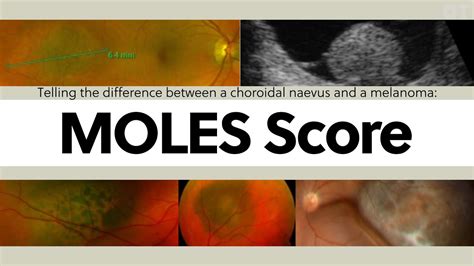 Telling The Difference Between A Choroidal Naevus And A Melanoma The