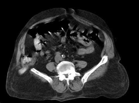 Radiopaedia Case Petit Hernia Id 33450 Study 34500 NC Commons