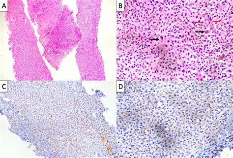 Undifferentiated Embryonal Sarcoma Of Liver With Macroaneurysms And