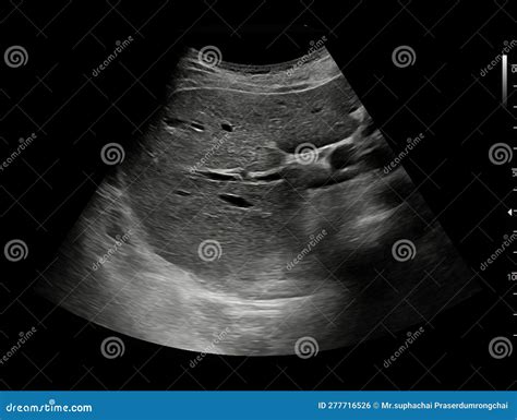 Ultrasound Upper Abdomen Showing Liver And Gall Bladder For Screening