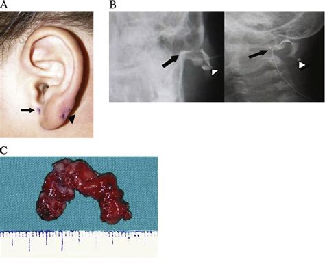 Periauricular Skin Pits Semantic Scholar