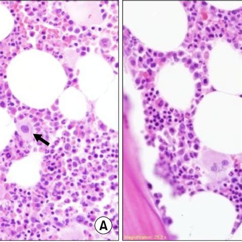 Bone Marrow Biopsy In The Patient Shows Hypercellular Marrow