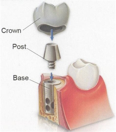 Trồng răng implant là gì cấy ghép răng Implant Nha khoa