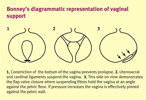 Uterine Prolapse Preservation Or Excision Obstetrics Gynaecology