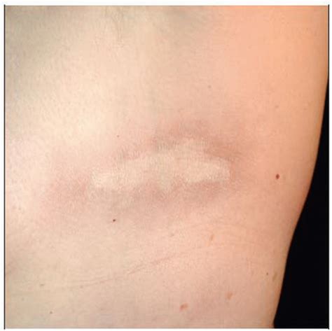 Morphea Scleroderma Basicmedical Key