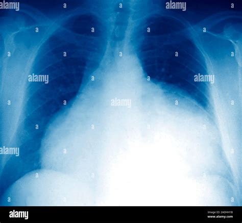 Enlarged Heart Frontal Chest X Ray Of The Massively Enlarged Heart Cardiomegaly White Lower