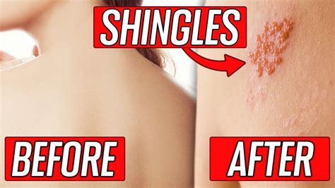 The Stages, Signs & Symptoms of Shingles – AO Biologix