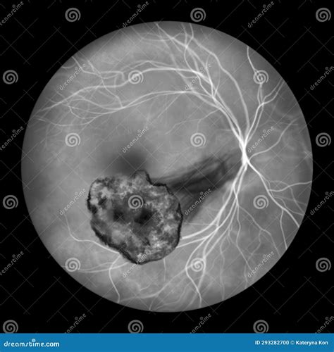 Toxoplasma Retinochoroiditis Stock Illustrations – 3 Toxoplasma Retinochoroiditis Stock ...