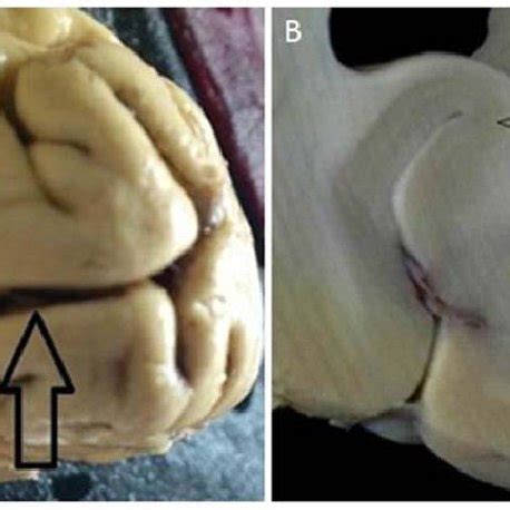 (A) The primary visual cortex is located in and around the calcarine ...