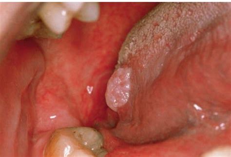 Papilloma On Tongue Medizzy