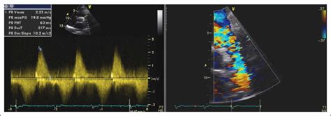 Left Continuous Wave Doppler At Right Ventricular Outflow Tract Download Scientific Diagram