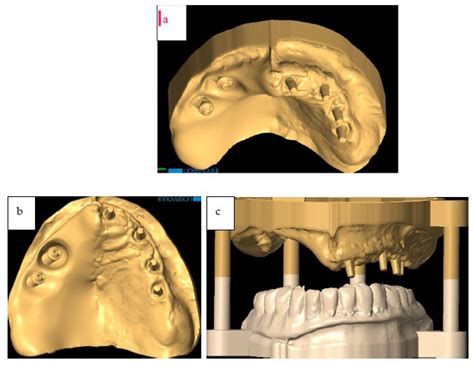 Guided Zygomatic Implantology for Oral Cancer Rehabilitation: A Case Report