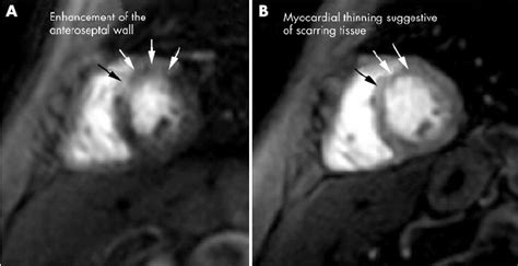 Gd DTPA First Pass Perfusion MRI In Short Axis View A Before