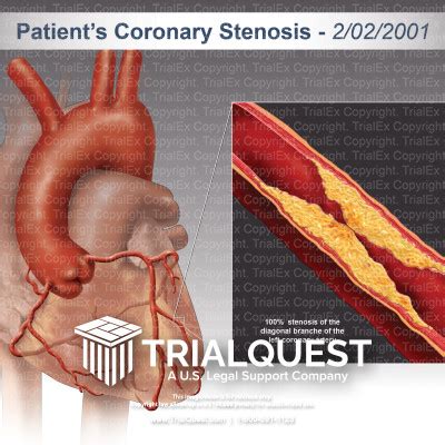 Coronary Stenosis Trialexhibits Inc