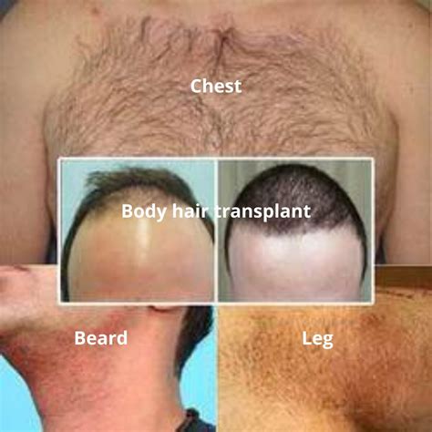 Types Of Chest Hair Atelier Yuwaciaojp