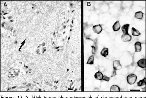 Figure 1 From Aids Related Extrapulmonary Pneumocystis Carinii Infection Presenting As A