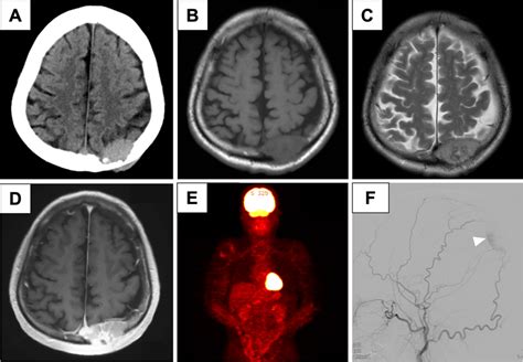 Preoperative Radiographic Imaging A An Axial Ct Image Showing A