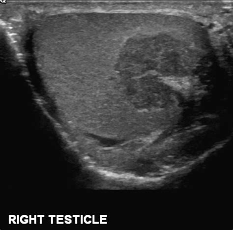 Testicular Adrenal Rest Tumor TART Image Radiopaedia Org