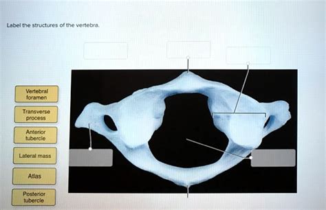 SOLVED Label The Structures Of The Vertebra Vertebral Foramen