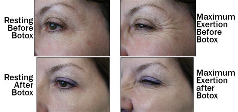 Botox For Wrinkles Baylor Medicine