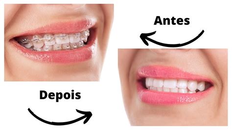 Aparelho Ortod Ntico Antes E Depois Confira O Resultado