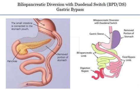 Gastric Bypass Surgery In India Gastric Bypass