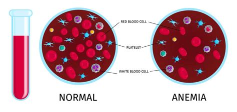 What’s Sickle Cell Disease, causes, symptoms and treatmentt? - Jalees