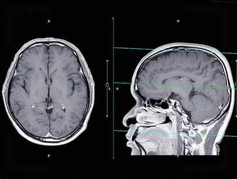 Pituitary Adenoma Of The Brain In Adults Symptoms Diagnosis And