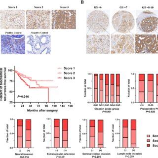 CCL20 Indicated Poor Prognosis In PCa Patients A Representative Of