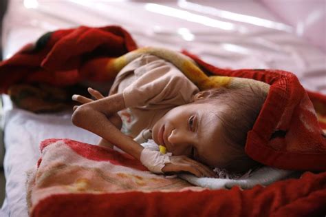 Au Yémen les enfants meurent de faim