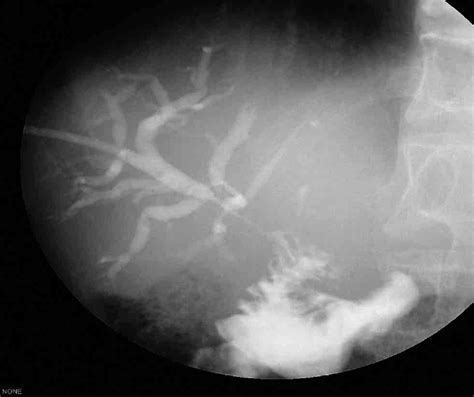 Percutaneous Transhepatic Biliary Drainage PTBD Showing Interruption