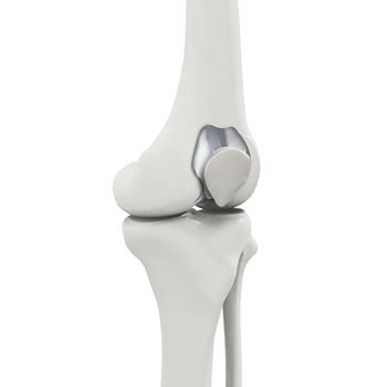 Patellofemoral Knee Joint Replacement Cary, NC | Patellofemoral Pain ...