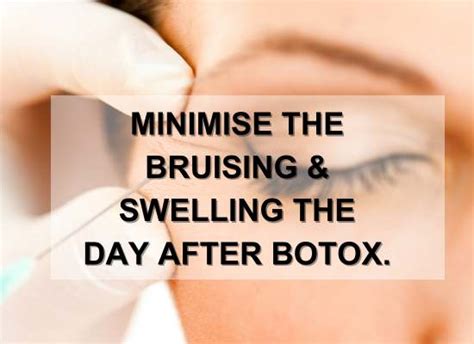 10 Easy Tips To Prevent Bruising From Botox And Fillers