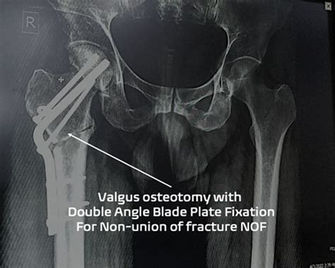 Hip Osteotomy - Dr Roy Joint Clinic