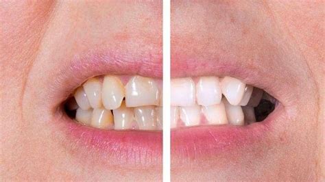 How to Get Rid of Yellow Teeth | Teeth Whitening Parker CO