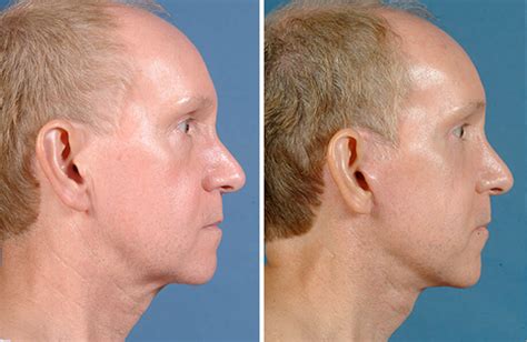 Facelift Austin Tx Dr Weinfeld