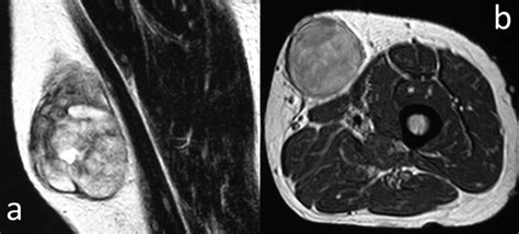 Aggressive Malignant Peripheral Nerve Sheath Tumor Of The Lower Limb In