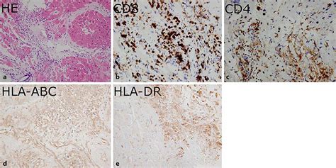 Pathological Findings Of Myocardial Biopsy A Myocardial Tissue Stained