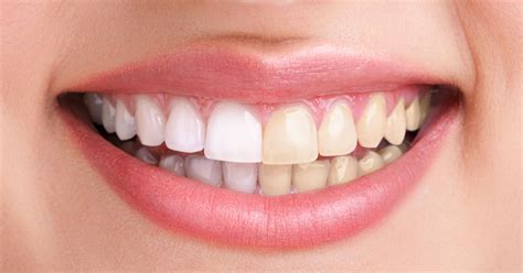 6 natural tooth whitening methods