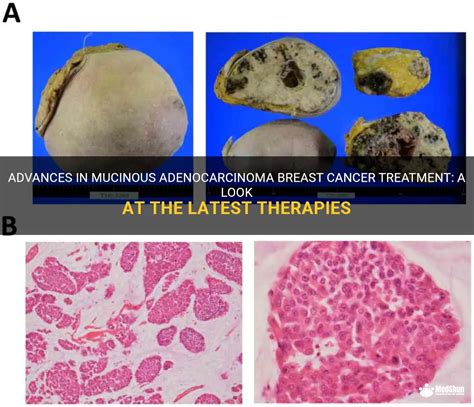 Advances In Mucinous Adenocarcinoma Breast Cancer Treatment: A Look At ...