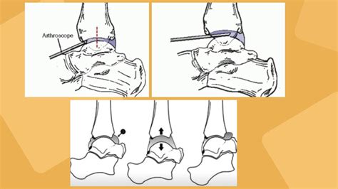 Artroscopia Anterior De Tobillo Bases E Introducci N Doryos