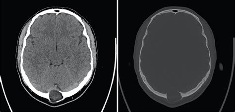 A Rare Cause Of Increased Intracranial Pressure And Papilloedema An