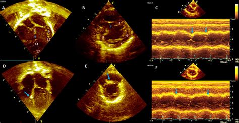 (A) Apical 4-chamber view shows large unrepaired muscular VSD in a... | Download Scientific Diagram