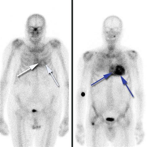 Síntomas de amiloidosis Amiloidosis Que es Sintomas Tratamiento