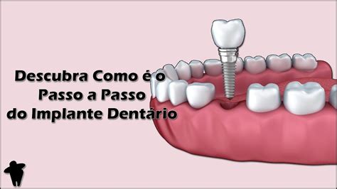 Cid Cirurgia Implante Dentário BRAINCP