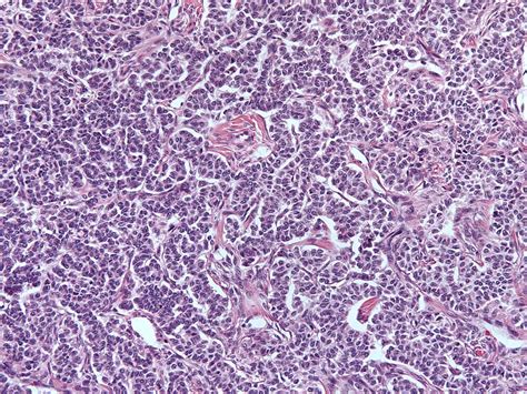 Tumor Granulosa Cell Tumor